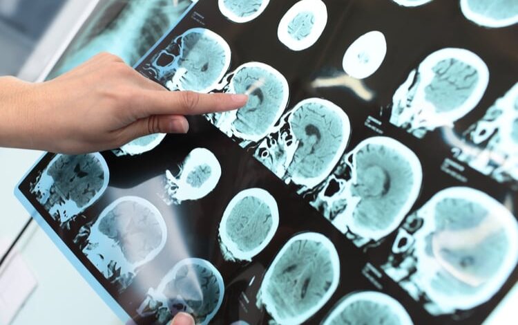 Alzheimer là gì? Làm thế nào để kiểm soát bệnh? • Hello Bacsi