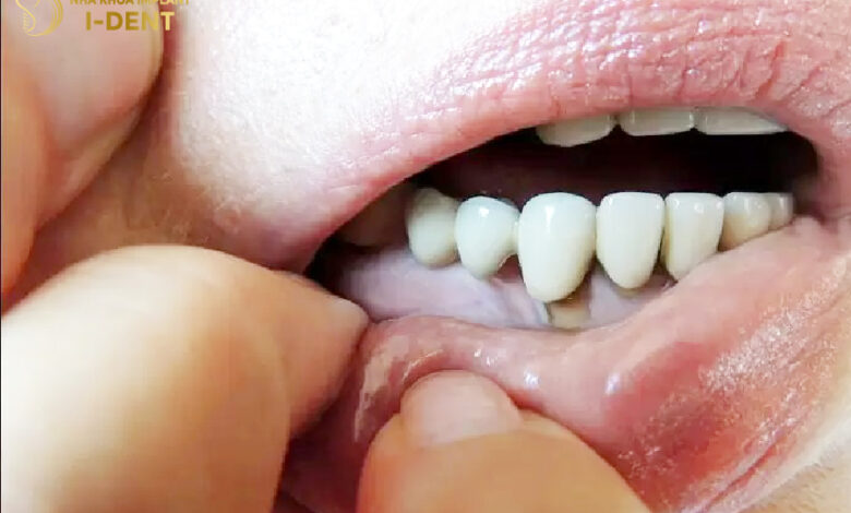 Bảng Giá Bọc Răng Sứ Mới Nhất Hiện Nay 2023 - Nha Khoa I-Dent