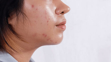 Quy trình các bước Skincare cho da dầu mụn ngày và đêm
