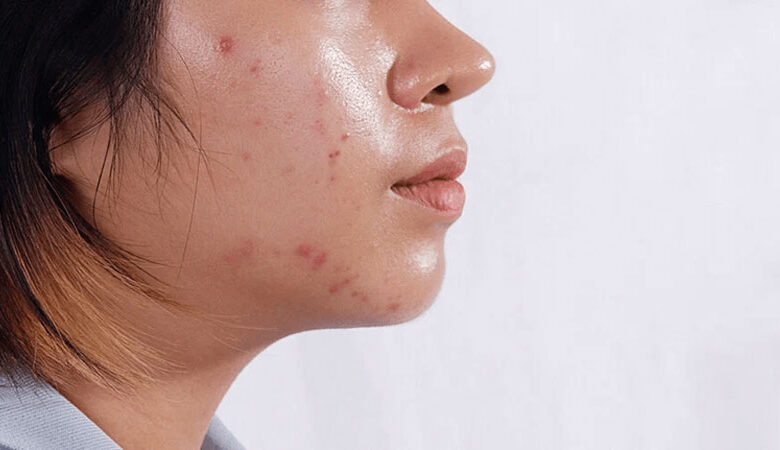 Quy trình các bước Skincare cho da dầu mụn ngày và đêm