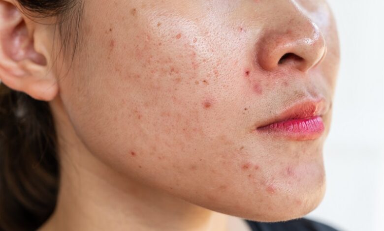 Các bước skincare chăm sóc cho da dầu mụn đúng chuẩn tại nhà