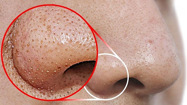 Mụn đầu đen thường hình thành ở mũi
