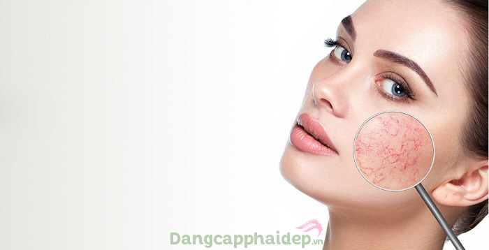 5 bí quyết trị giãn mao mạch tại nhà đơn giản từ thiên nhiên