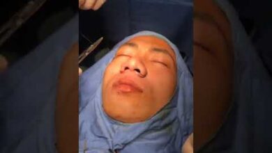 9 Cách để thu nhỏ cánh mũi: Tự nhiên, Đơn giản, An toàn