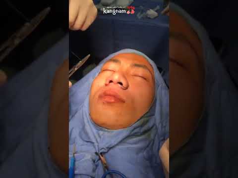 9 Cách để thu nhỏ cánh mũi: Tự nhiên, Đơn giản, An toàn