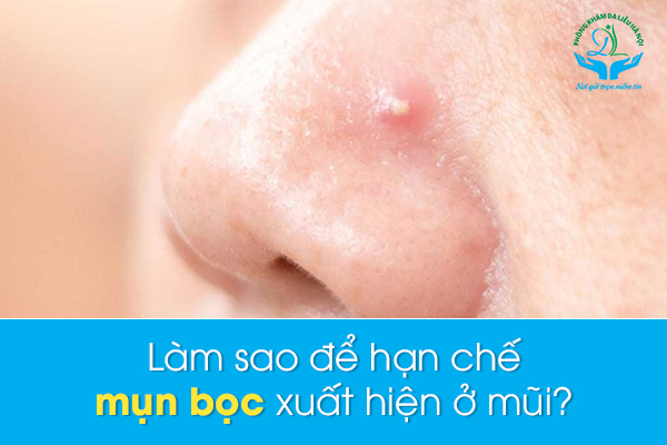 Cách trị mụn bọc sưng tấy quanh mũi tại nhà không để lại sẹo bạn