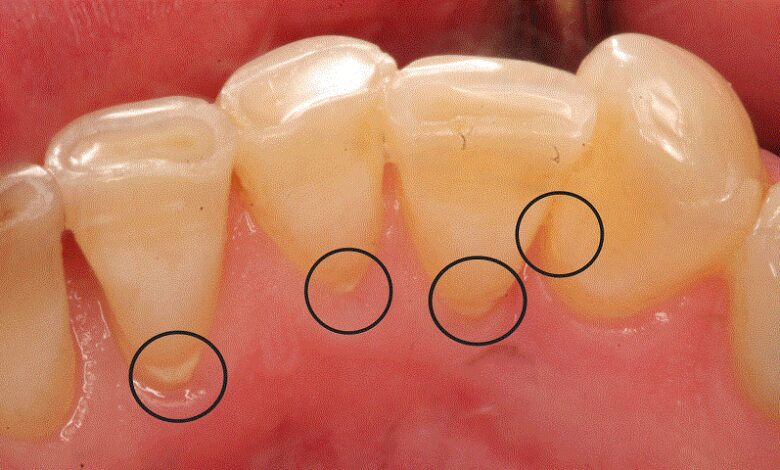 Cao răng là gì và những điều nên biết về lấy cao răng | Medlatec