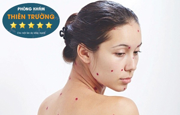 Bí quyết chăm sóc da sau khi bị thuỷ đậu