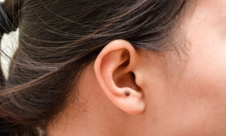 Nốt ruồi ở cuống tai có ý nghĩa gì? Có nên tẩy không?