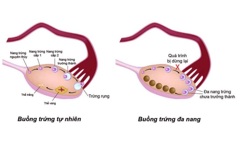 Nhận biết 7 dấu hiệu đa nang buồng trứng điển hình nhất | Medlatec