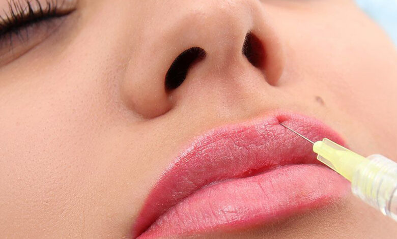 Tiêm filler môi là gì? 9 kiểu dáng môi tiêm filler đẹp thịnh hành nhất