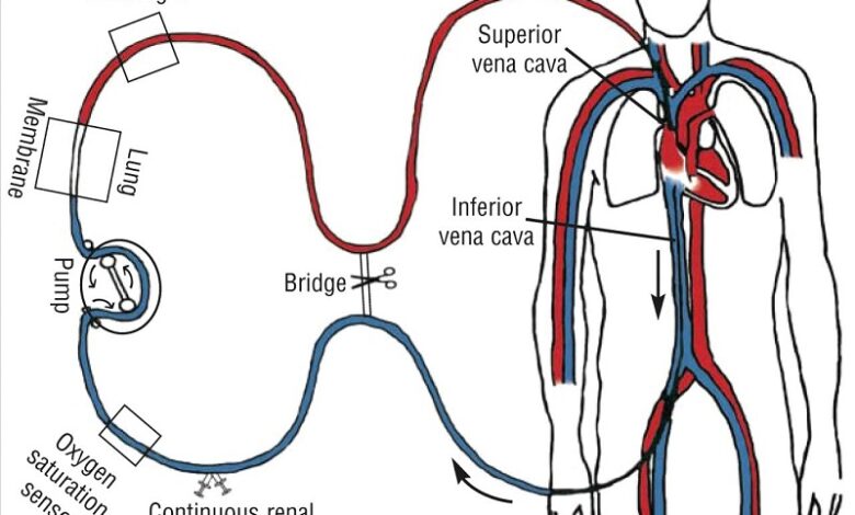 ECMO là gì và ý nghĩa của phương pháp này với người bệnh