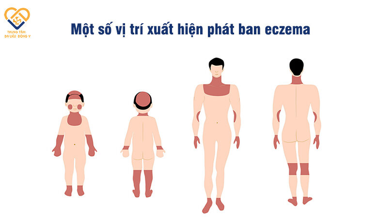 Bệnh Eczema: Nguyên Nhân, Triệu Chứng, Cách Điều Trị và Phòng