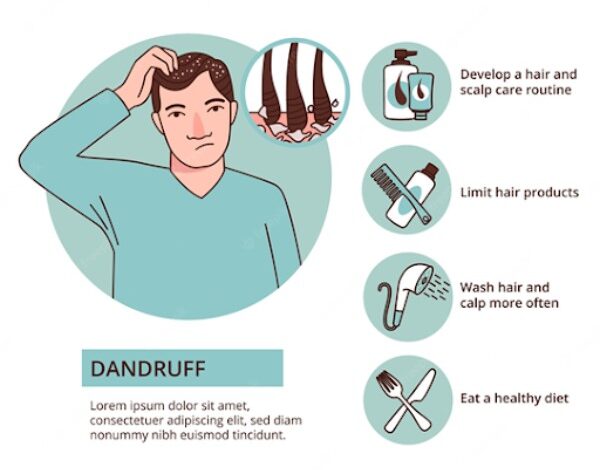 Gàu là gì? Nguyên nhân, triệu chứng và cách điều trị - YouMed