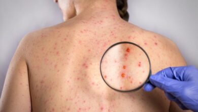 Bệnh zona thần kinh (giời leo) là gì? Mức độ nguy hiểm và cách