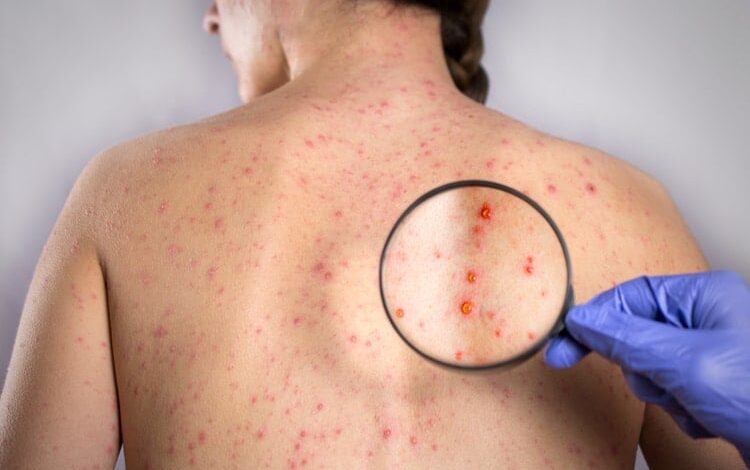 Bệnh zona thần kinh (giời leo) là gì? Mức độ nguy hiểm và cách