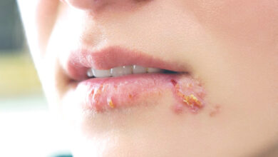 Herpes là bệnh gì, nguyên nhân và cách điều trị