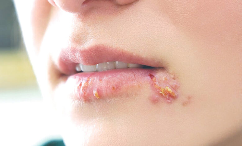 Herpes là bệnh gì, nguyên nhân và cách điều trị
