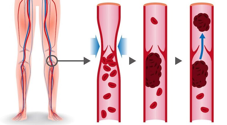 Bệnh huyết khối là gì, phương pháp điều trị ra sao? | Medlatec