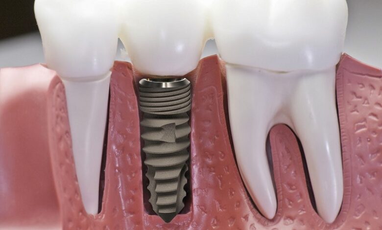 Cấy ghép Implant là gì - những điều nên biết trước khi thực hiện