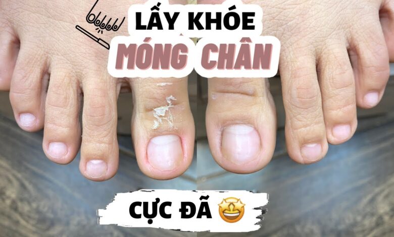 Làm thế nào để tôi biết tôi đang bị khoé móng chân?