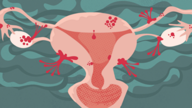 Lạc nội mạc tử cung là gì và những điều cần biết | Medlatec