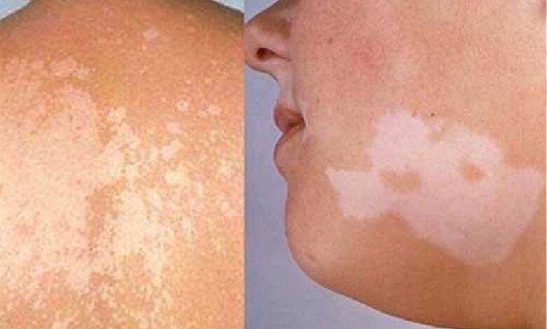 Bệnh lang ben là gì? Cách điều trị lang ben ra sao? | Medlatec