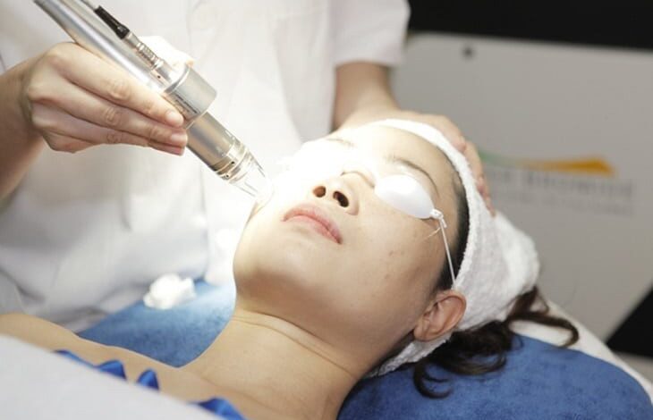 Trị mụn bằng laser: giá, cơ chế, lợi ích và những lưu ý - YouMed