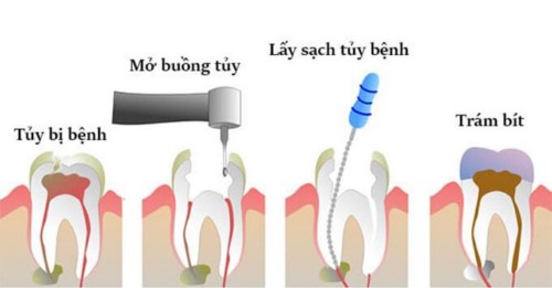Trám răng lấy tủy giá tổng cộng bao nhiêu? - Nha Khoa Đông Nam®