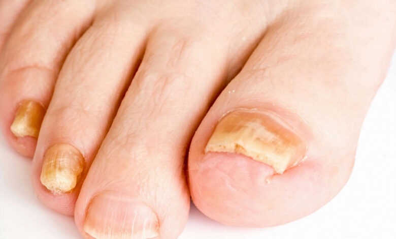 Sơn móng chân bị vàng móng: Nguyên nhân và cách khắc phục