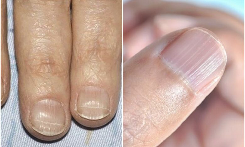 Móng tay bị sần gợn sóng là có đang bị bệnh gì không?