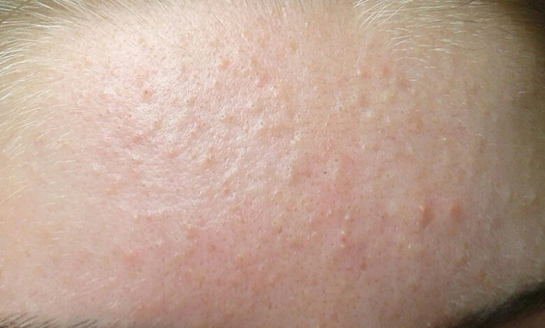 Mụn ẩn là gì? Biện pháp ngăn ngừa mụn ẩn dưới da