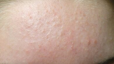 Các nguyên nhân dẫn đến mụn ẩn và cách điều trị mụn ẩn hiệu quả