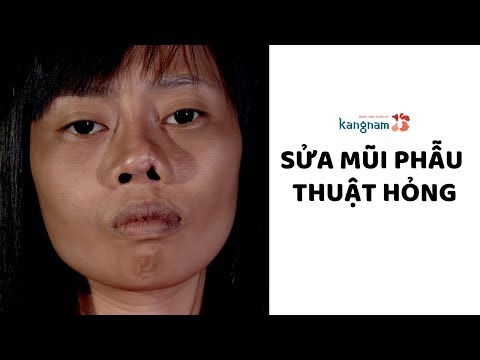 Nâng/sửa mũi tại Bệnh Viện Thẩm mỹ Kangnam - Giá cả và các dịch