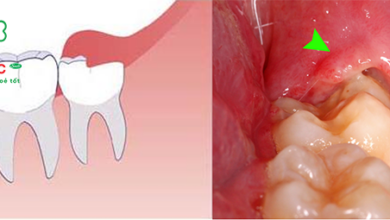 Giá nhổ răng số 8 bao nhiêu tiền? - Nha Khoa Tâm Đức Smile