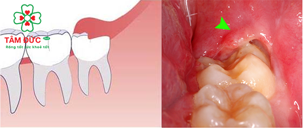 Giá nhổ răng số 8 bao nhiêu tiền? - Nha Khoa Tâm Đức Smile
