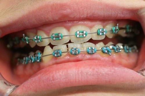 Giải Đáp: Chi phí NIỀNG RĂNG giá bao nhiêu tiền và mất bao lâu?