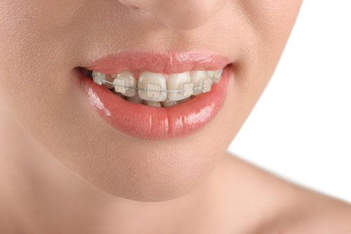 Giải Đáp: Chi phí NIỀNG RĂNG giá bao nhiêu tiền và mất bao lâu?