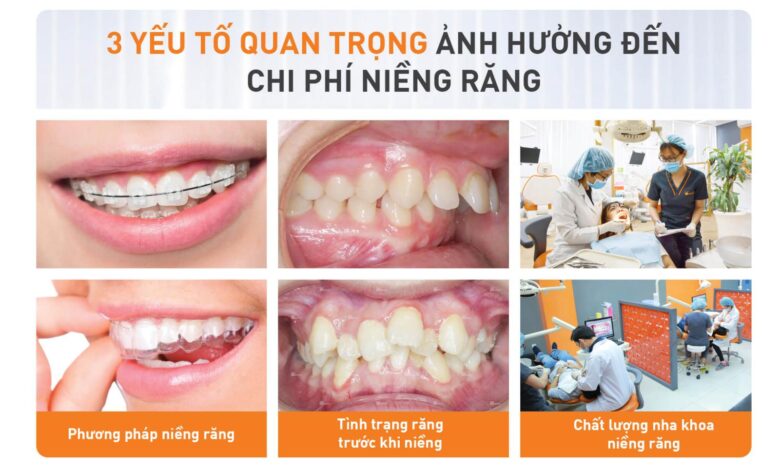 Bảng giá niềng răng chi tiết [2023] tại nha khoa Up Dental