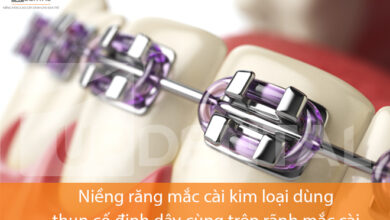 Giá niềng răng mắc cài kim loại mới nhất [2023] hiện nay - Up Dental