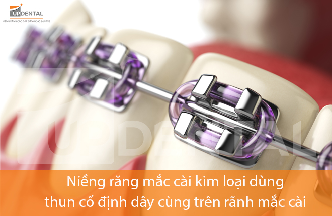 Giá niềng răng mắc cài kim loại mới nhất [2023] hiện nay - Up Dental