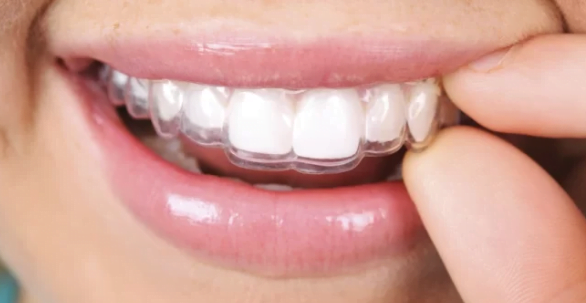 Giá niềng răng Invisalign bao nhiêu? - Nha Khoa Lan Anh