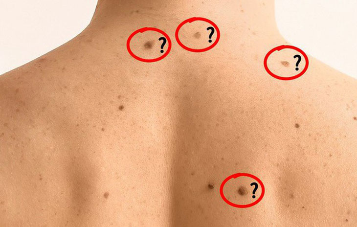 Nốt ruồi: Khi nào cần phá bỏ? - Bệnh viện Hồng Ngọc