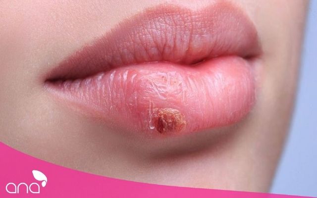 Phun Môi Bị Mụn Nước Có Để Lại Sẹo Không? Cách Chăm Sóc