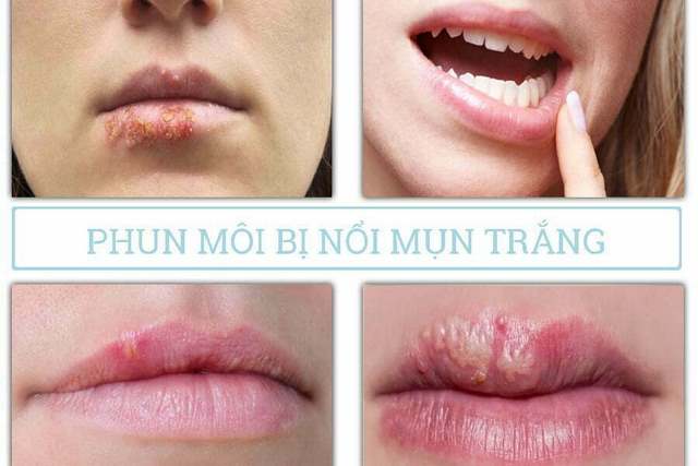 [Lý Do] Phun môi bị nổi mụn trắng: Nguyên nhân, cách xử lý an toàn