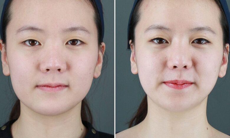 Phun môi có đau không? Những điều cần biết khi đi thẩm mỹ môi
