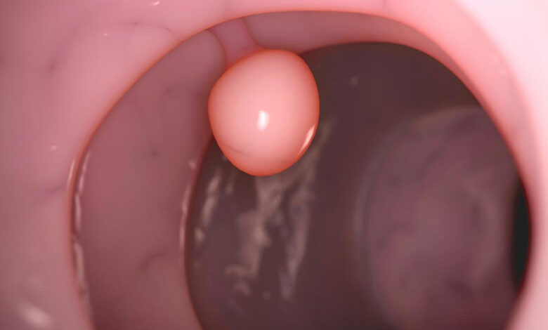 Polyp thường xuất hiện ở những cơ quan nào? | Medlatec