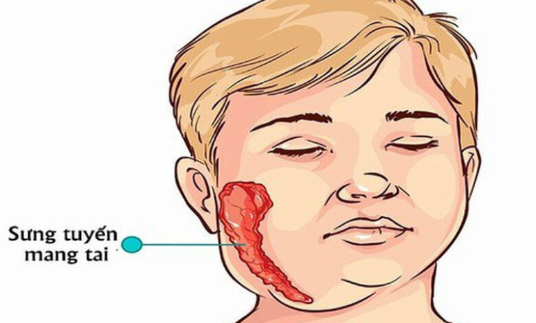 Chỉ điểm những triệu chứng quai bị dễ nhận diện | Medlatec