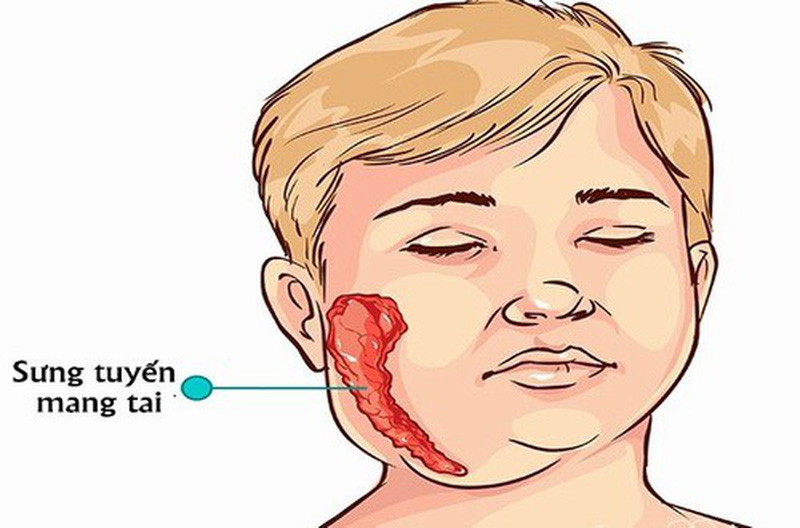 triệu chứng quai bị