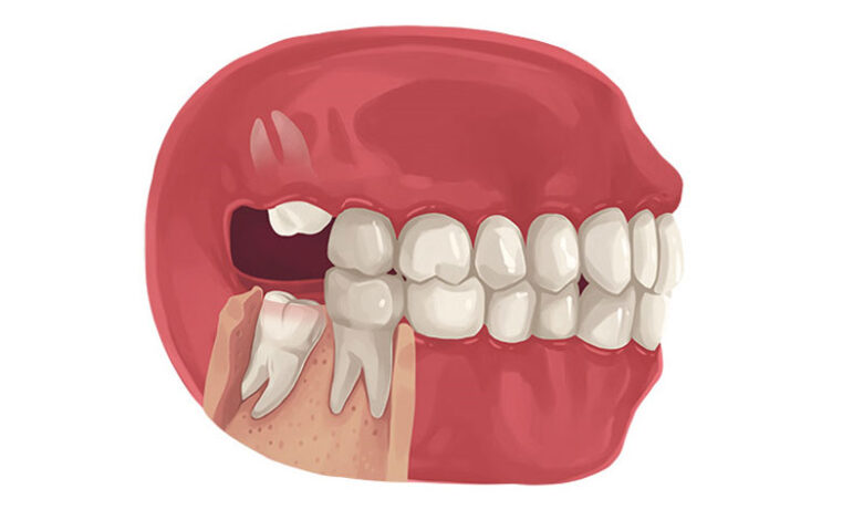 Răng khôn là gì và những trường hợp cần nhổ bỏ răng khôn?